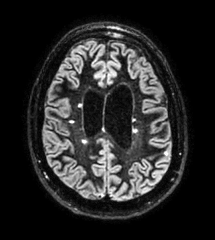 3D BrainVIEW Double IR - Axial reformat<b>Compressed SENSE</b>