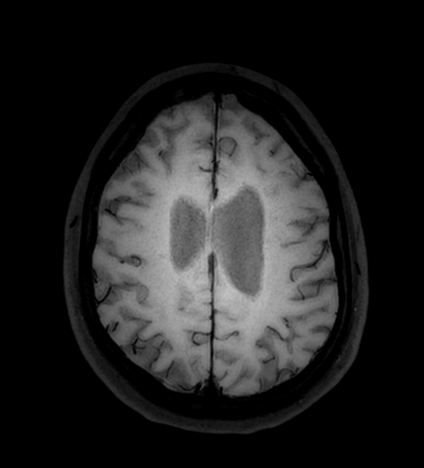 Axial 3D BrainVIEW Black Blood (post-gado)<b>Compressed SENSE</b>