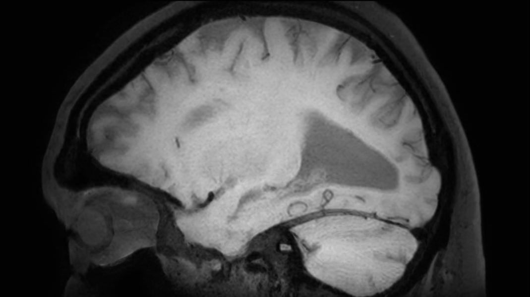 3D BrainVIEW Black Blood (post-gado) - Sagittal reformat<b>Compressed SENSE</b>