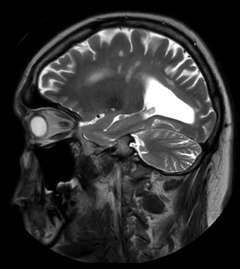 Sagittal T2w TSE MultiVane XD