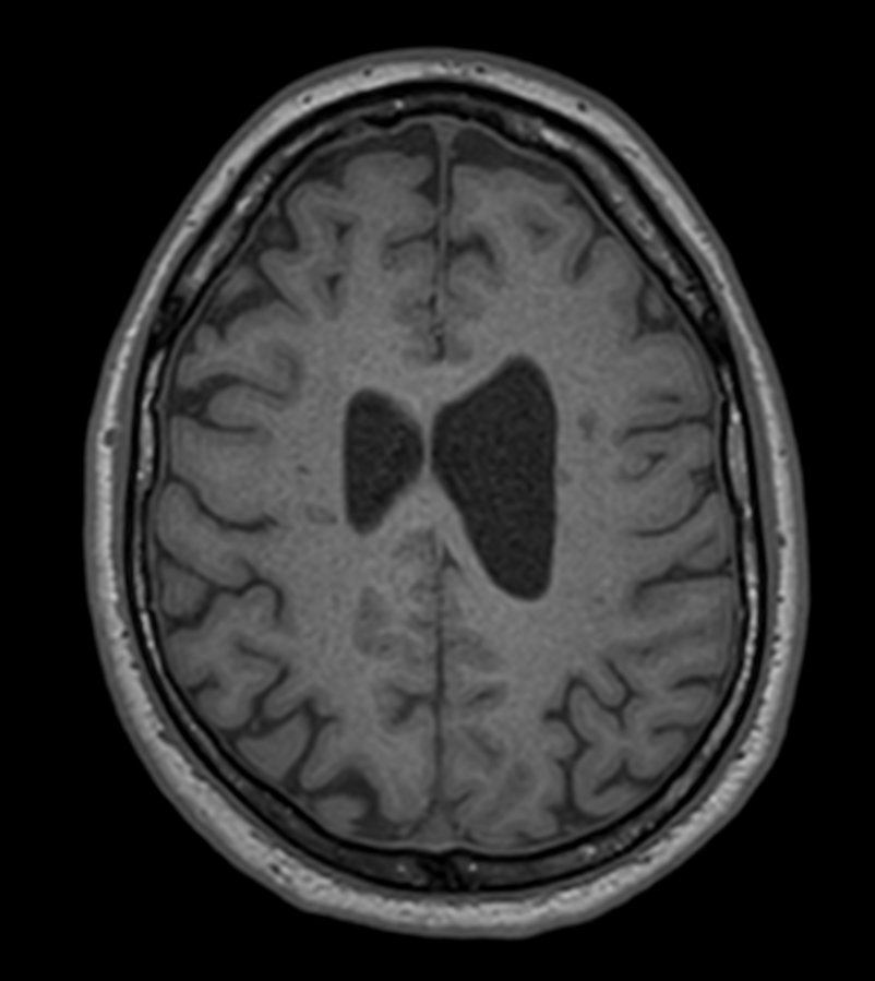 Axial 3D T1w TFE<b>Compressed SENSE</b>