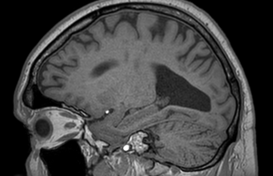 3D T1w TFE - Sagittal reformat<b>Compressed SENSE</b>