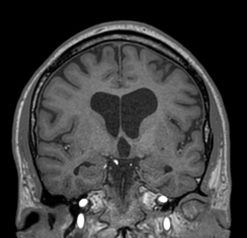 3D T1w TFE - Coronal reformat<b>Compressed SENSE</b>