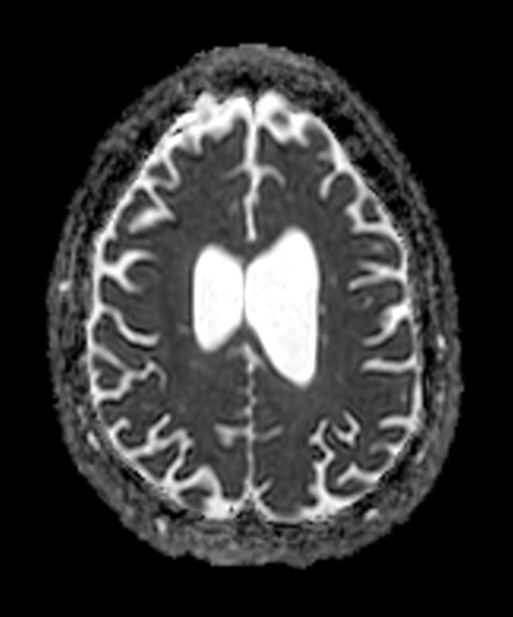 Axial DWI b1000 (ADC)