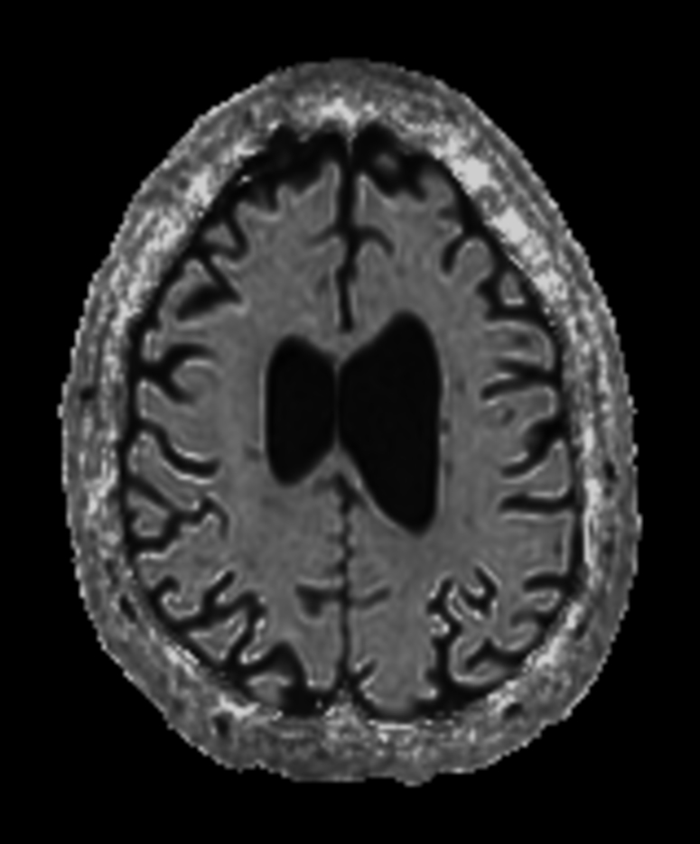 Axial DWI b1000 (eADC)
