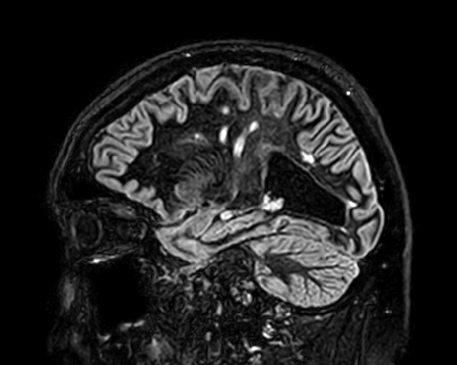 Sagittal 3D BrainVIEW Double IR