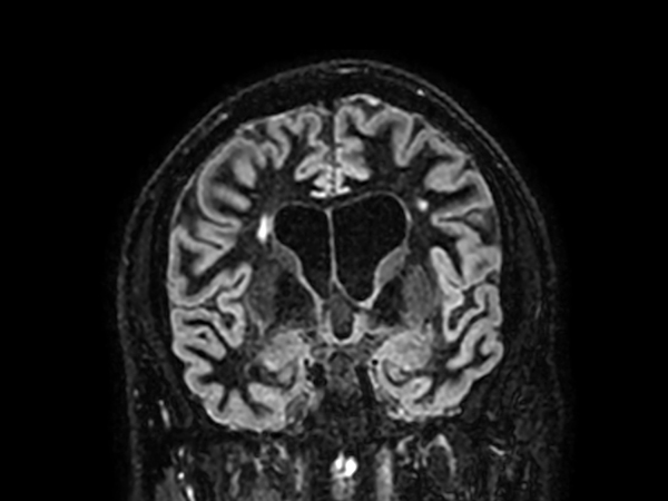 3D BrainVIEW Double IR - Coronal reformat