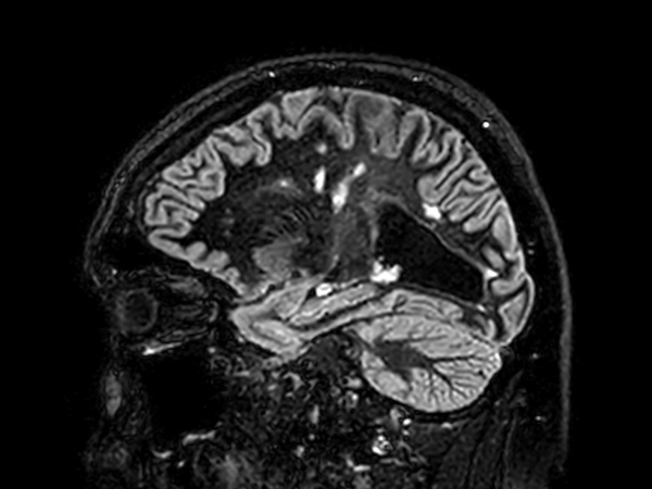 Sagittal 3D BrainVIEW Double IR<b>Compressed SENSE</b>