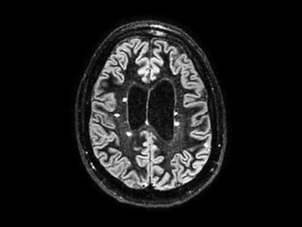 3D BrainVIEW Double IR - Axial reformat<b>Compressed SENSE</b>