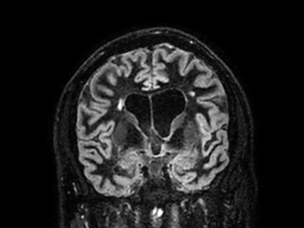 3D BrainVIEW Double IR -  Coronal reformat<b>Compressed SENSE</b>