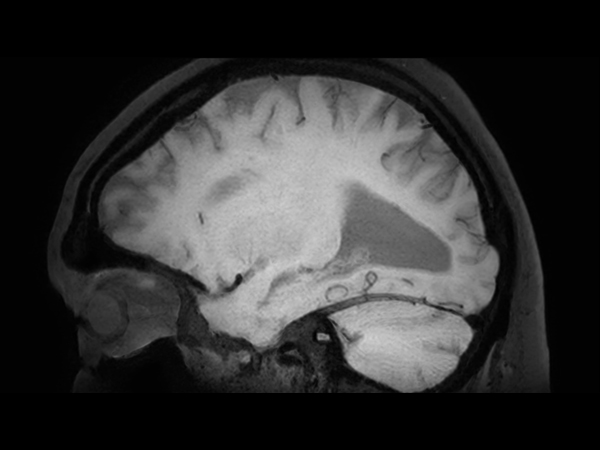 3D BrainVIEW Black Blood (post-gado) - Sagittal reformat<b>Compressed SENSE</b>