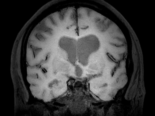 3D BrainVIEW Black Blood (post-gado) - Coronal reformat<b>Compressed SENSE</b>