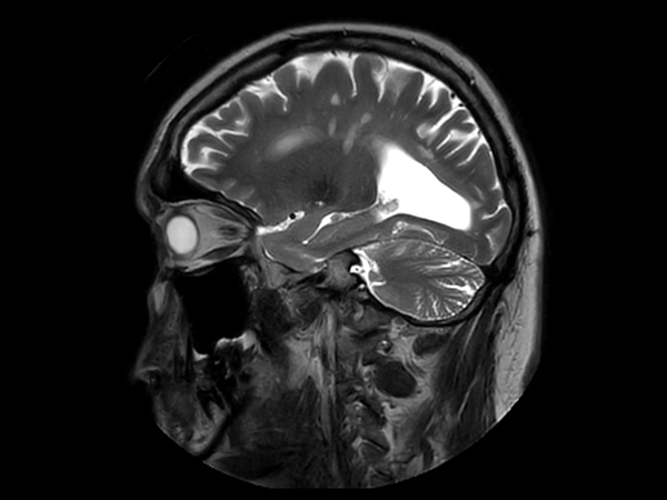 Sagittal T2w TSE MultiVane XD