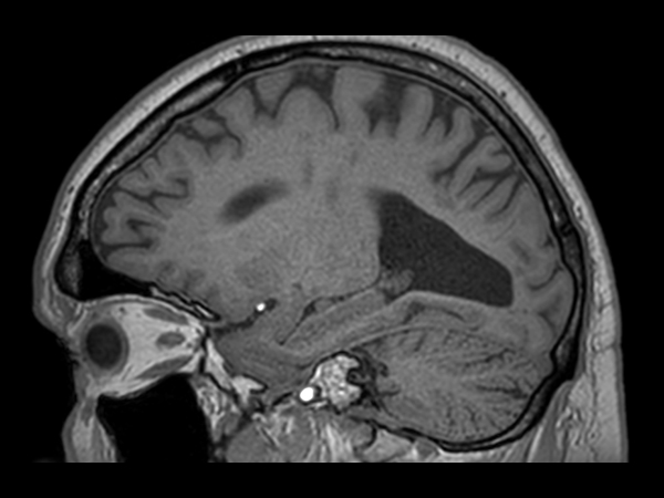 3D T1w TFE - Sagittal reformat<b>Compressed SENSE</b>