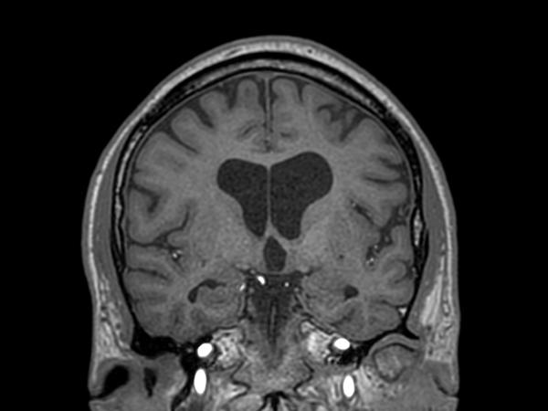 3D T1w TFE - Coronal reformat<b>Compressed SENSE</b>