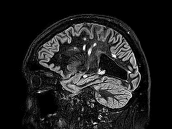 Sagittal 3D BrainVIEW Double IR