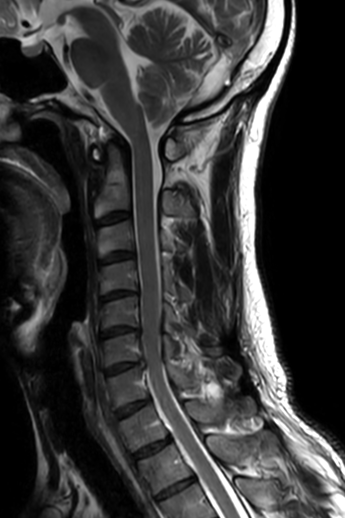 Sagittal T2w TSE - Compressed SENSE