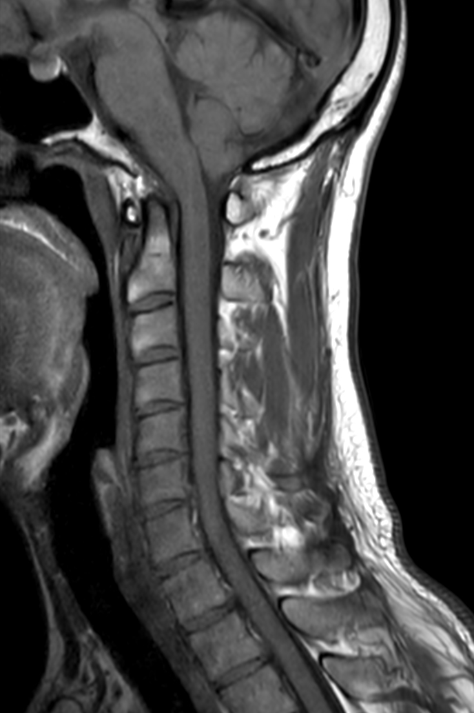 Sagittal T1w TSE - Compressed SENSE