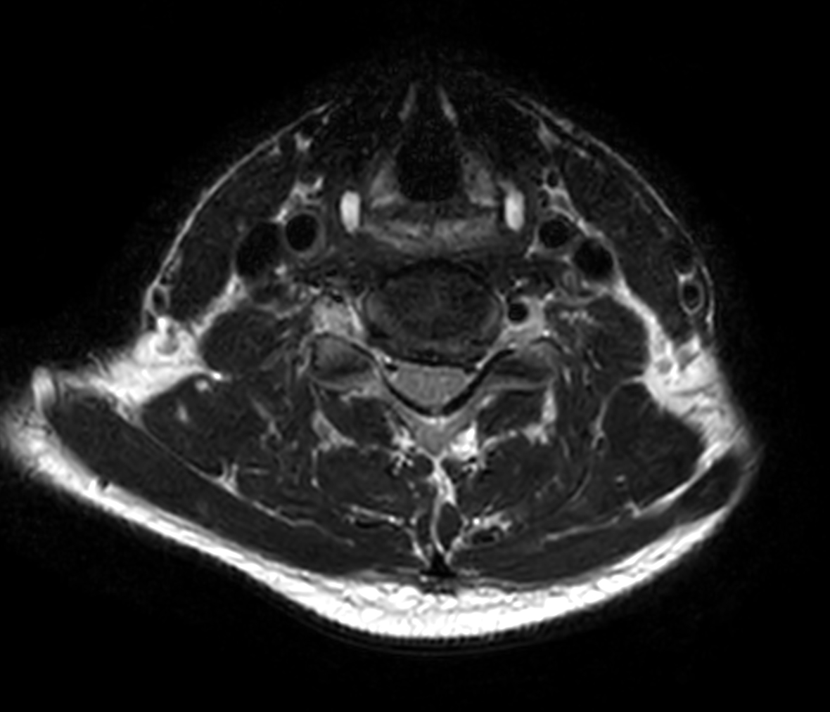 Axial T2w TSE - Compressed SENSE