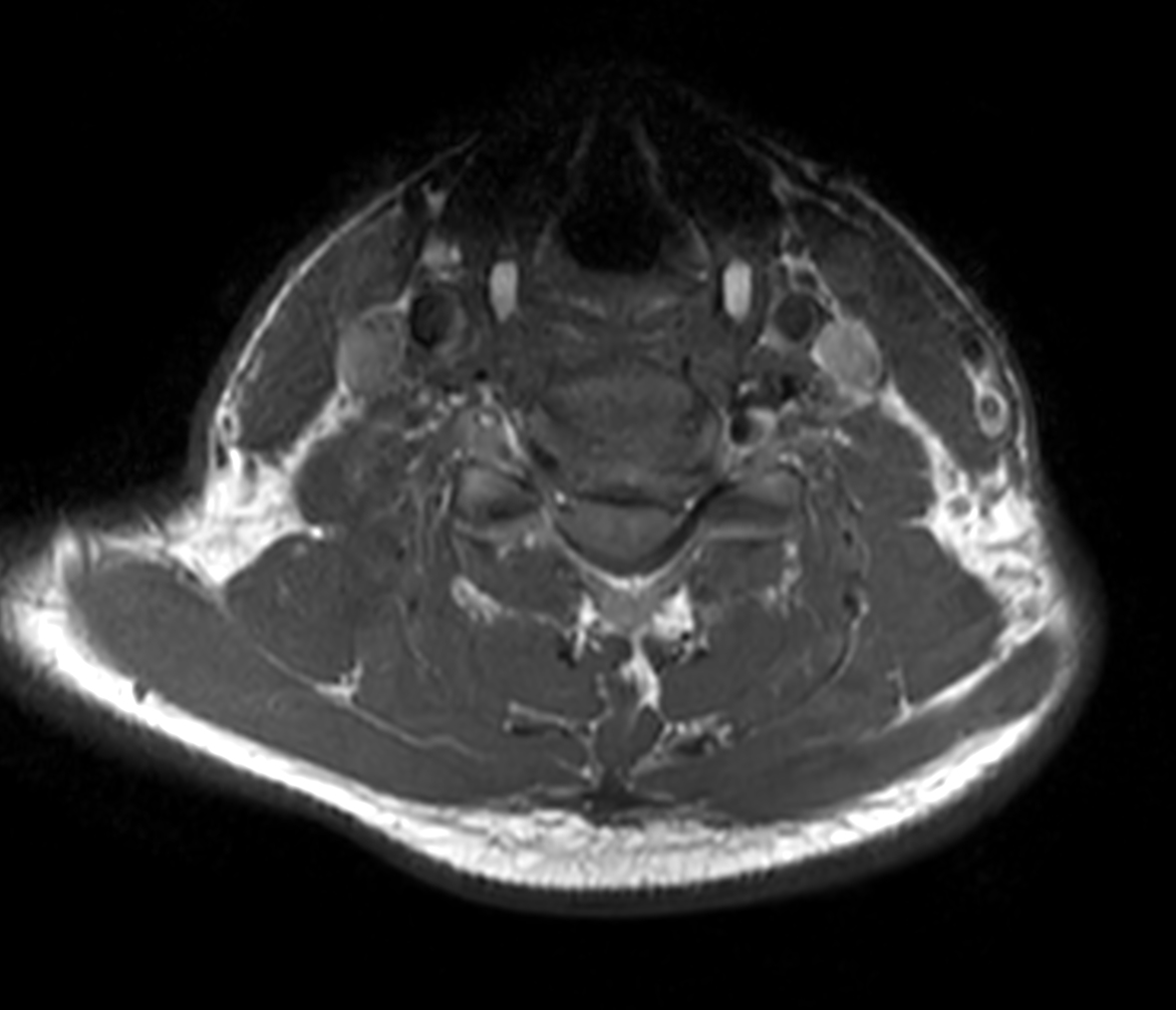 Axial T1w TSE - Compressed SENSE