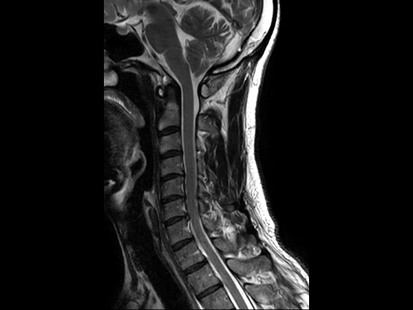 Sagittal T2w TSE