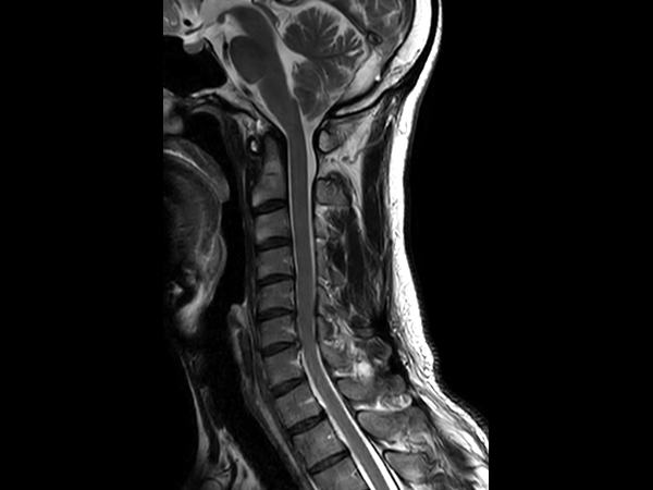 Sagittal T2w TSE - Compressed SENSE