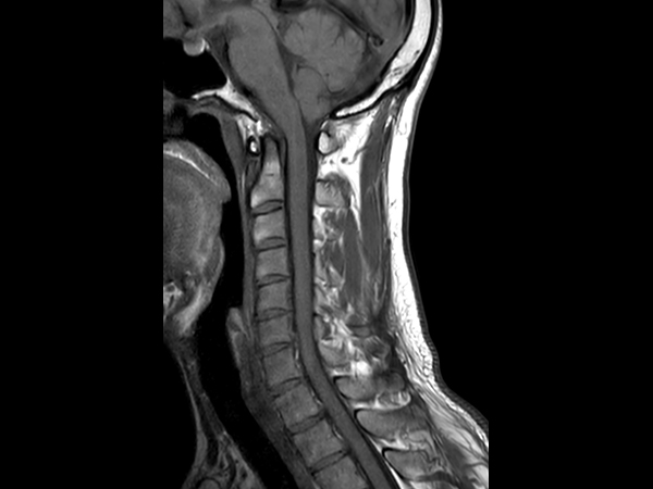 Sagittal T1w TSE - Compressed SENSE