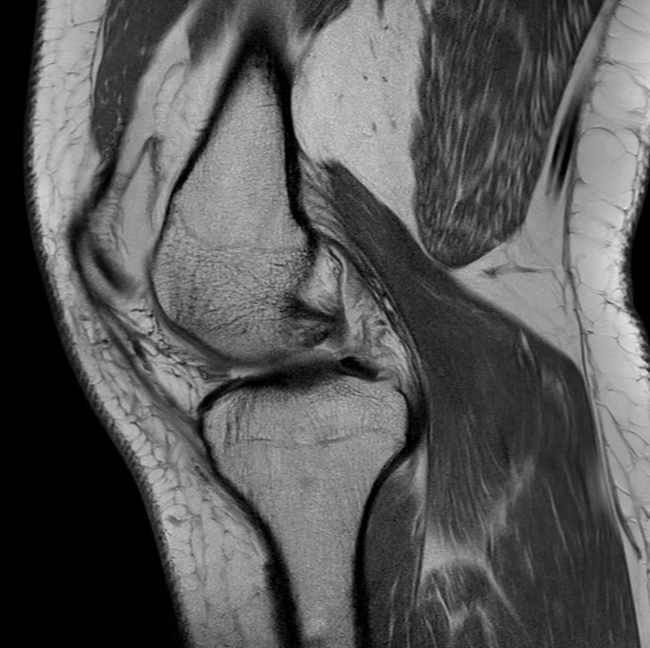Sagittal PDw aTSE<b>No Compressed SENSE</b>