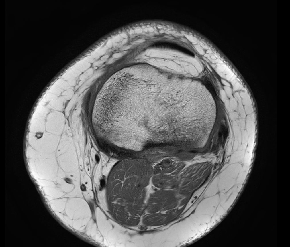 Axial T1w TSE<b>Compressed SENSE</b>