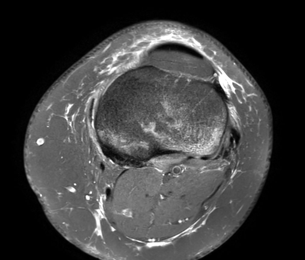 Axial PDw SPAIR<b>No Compressed SENSE</b>