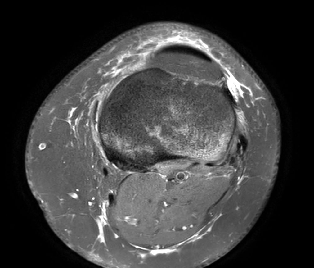 Axial PDw SPAIR<b>Compressed SENSE</b>