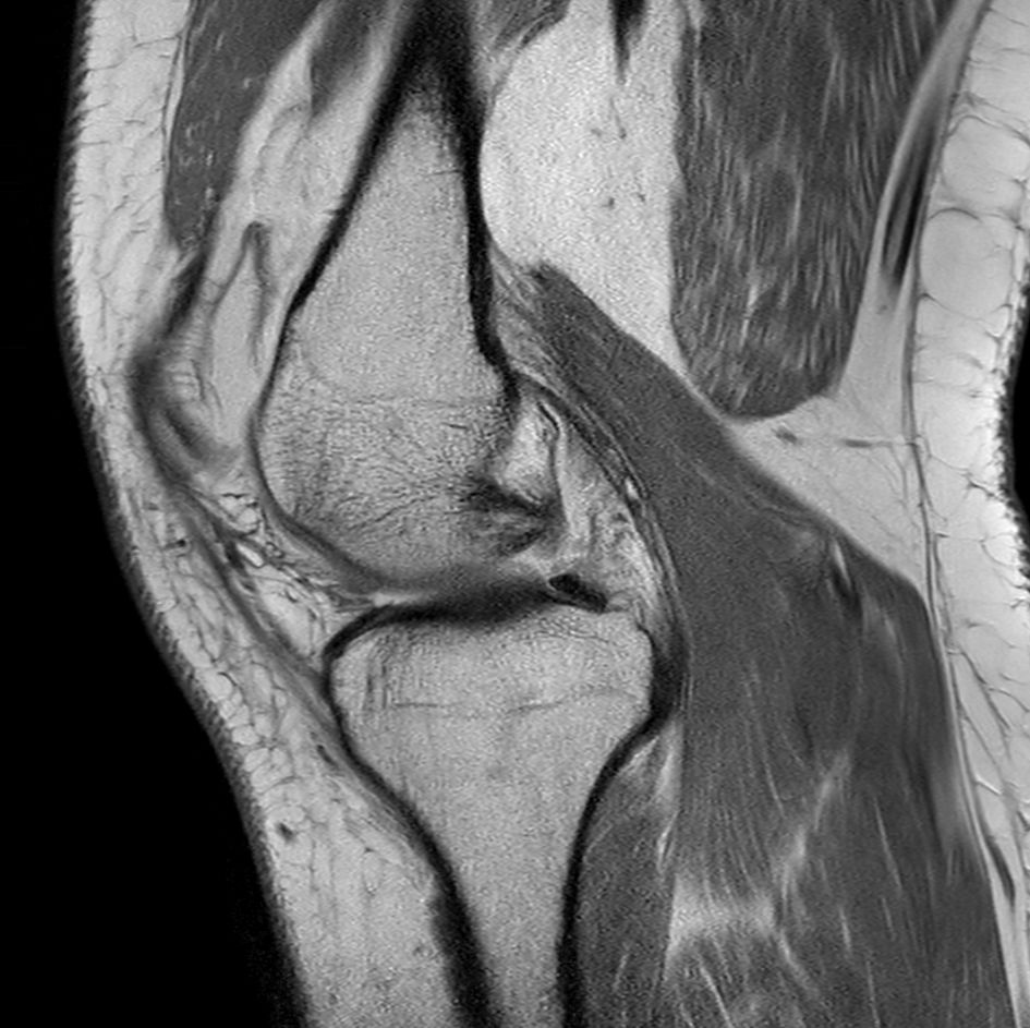 Sagittal PDw aTSE<b>Compressed SENSE</b>