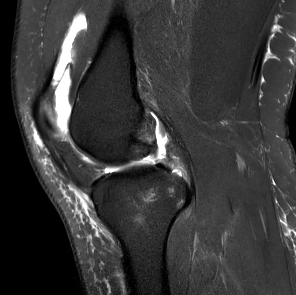 Sagittal T2w SPAIR<b>No Compressed SENSE</b>