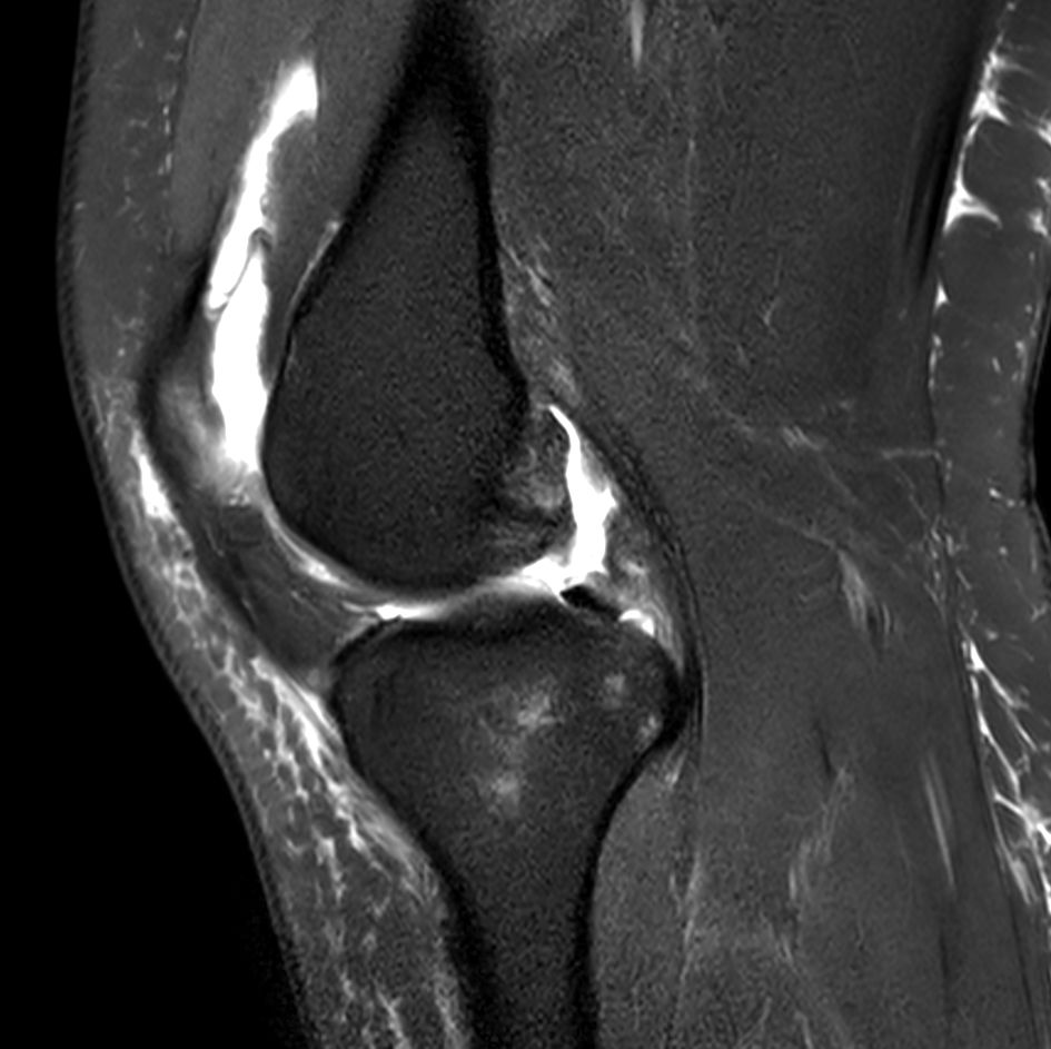 Sagittal T2w SPAIR<b>Compressed SENSE</b>