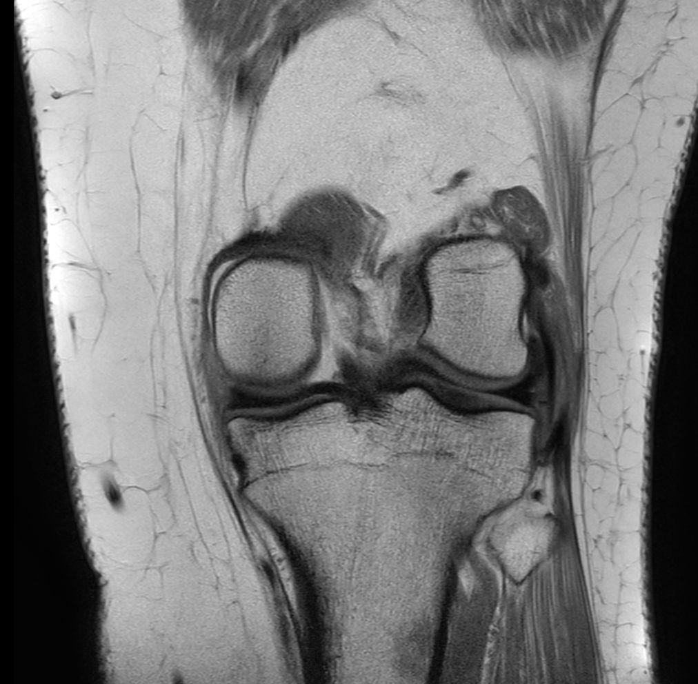 Coronal PDw aTSE<b>No Compressed SENSE</b>