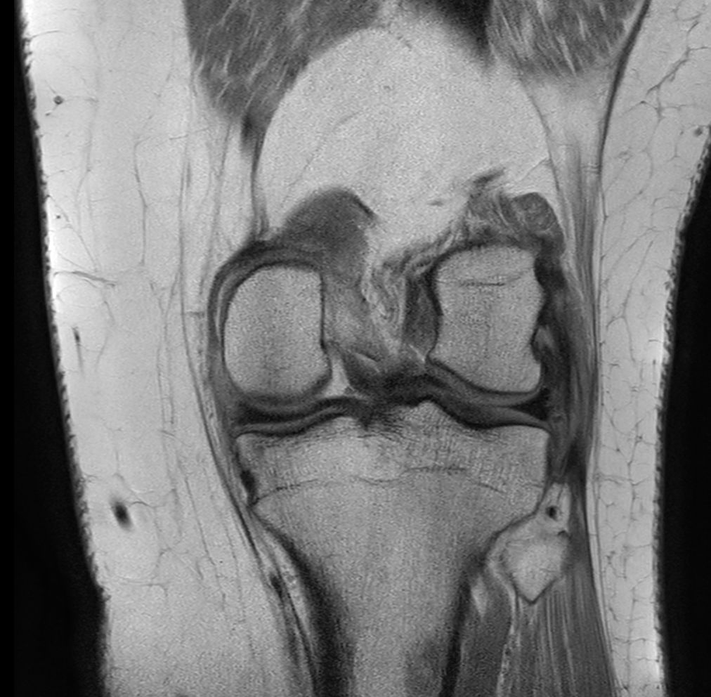 Coronal PDw aTSE<b>Compressed SENSE</b>