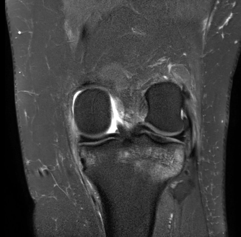 Coronal PDw SPAIR<b>No Compressed SENSE</b>