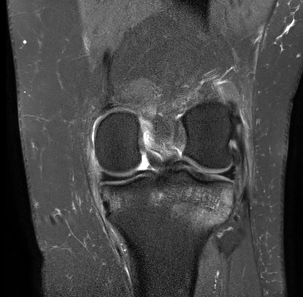Coronal PDw SPAIR<b>Compressed SENSE</b>