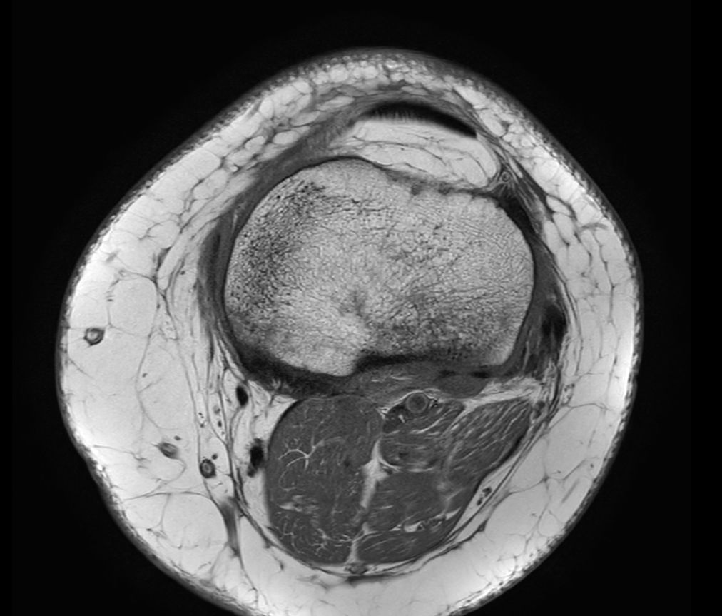 Axial T1w TSE<b>No Compressed SENSE</b>