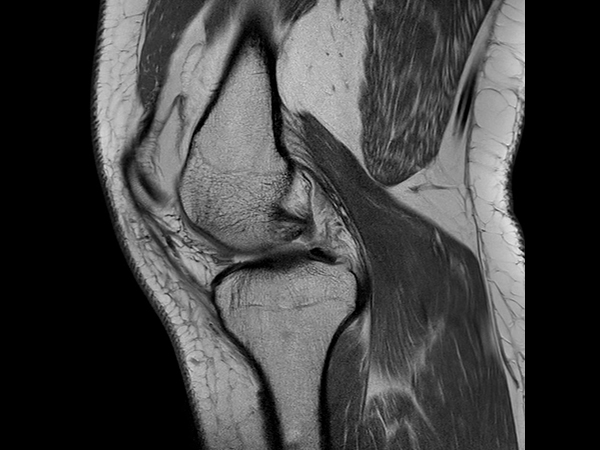 Sagittal PDw aTSE<b>No Compressed SENSE</b>