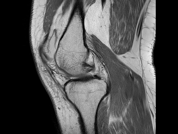 Sagittal PDw aTSE<b>Compressed SENSE</b>