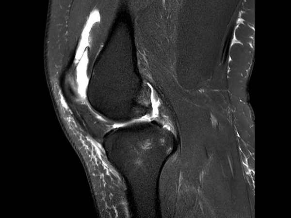 Sagittal T2w SPAIR<b>No Compressed SENSE</b>