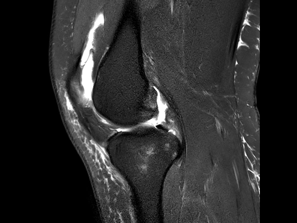 Sagittal T2w SPAIR<b>Compressed SENSE</b>