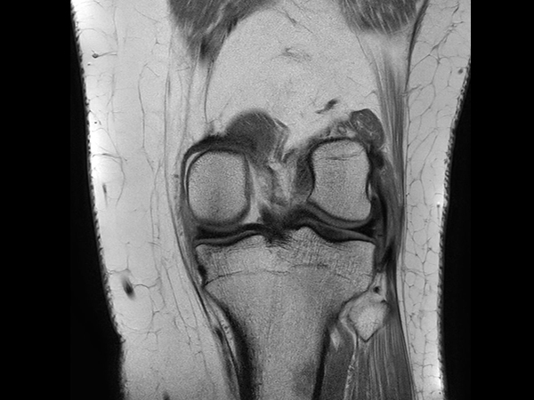 Coronal PDw aTSE<b>No Compressed SENSE</b>