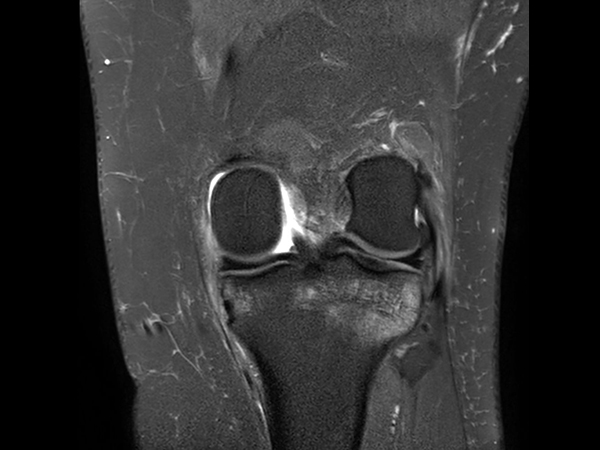 Coronal PDw SPAIR<b>No Compressed SENSE</b>