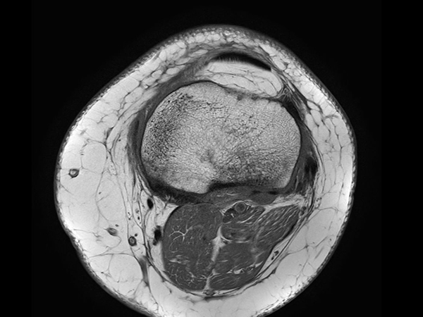 Axial T1w TSE<b>No Compressed SENSE</b>