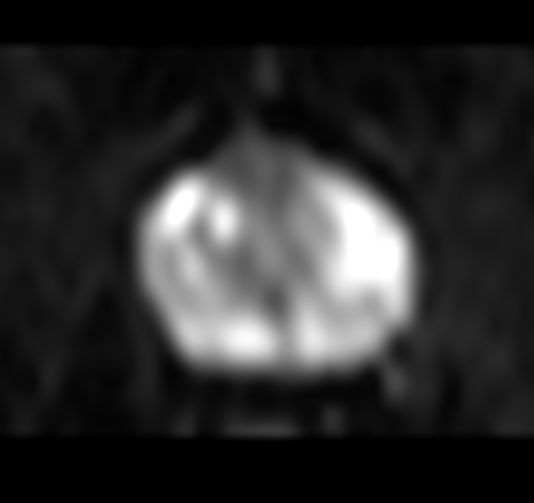 Axial DWI b100<b>Gradient strength: Enhanced</b>