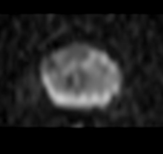 Axial DWI b1000<b>Gradient strength: Enhanced</b>