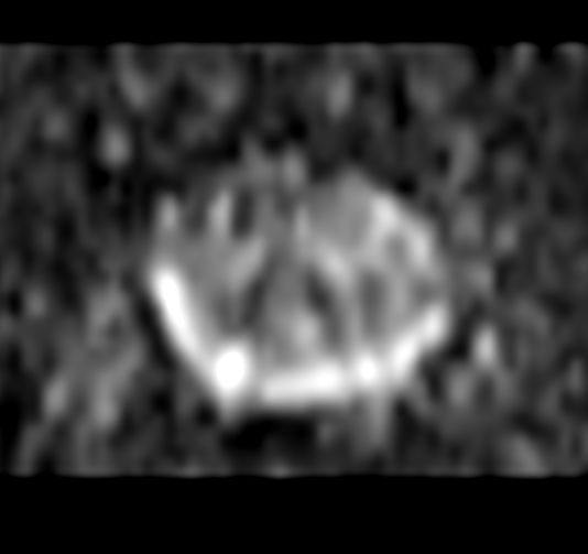 Axial DWI b2000<b>Gradient strength: Enhanced</b>