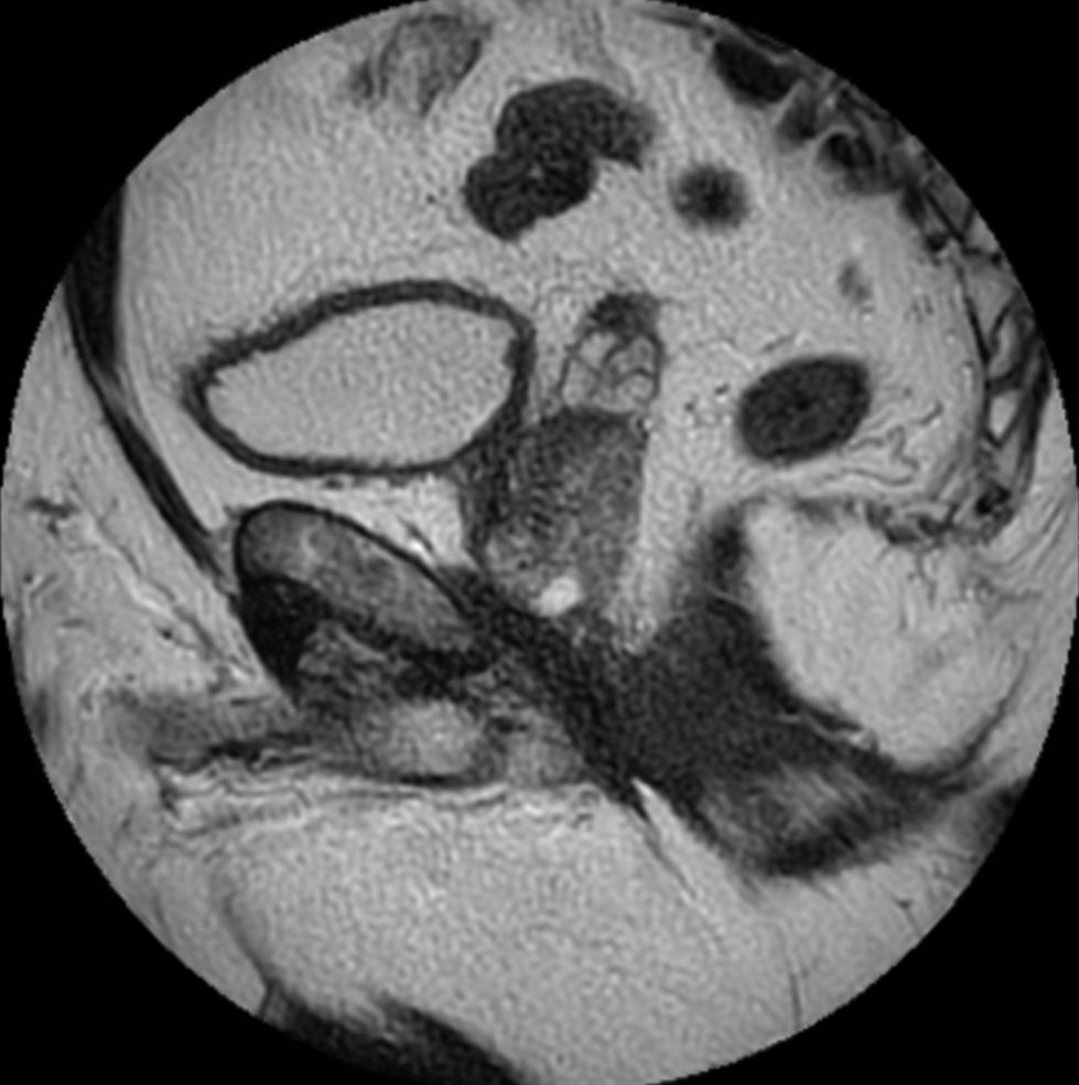 Sagittal T2w TSE MultiVane XD